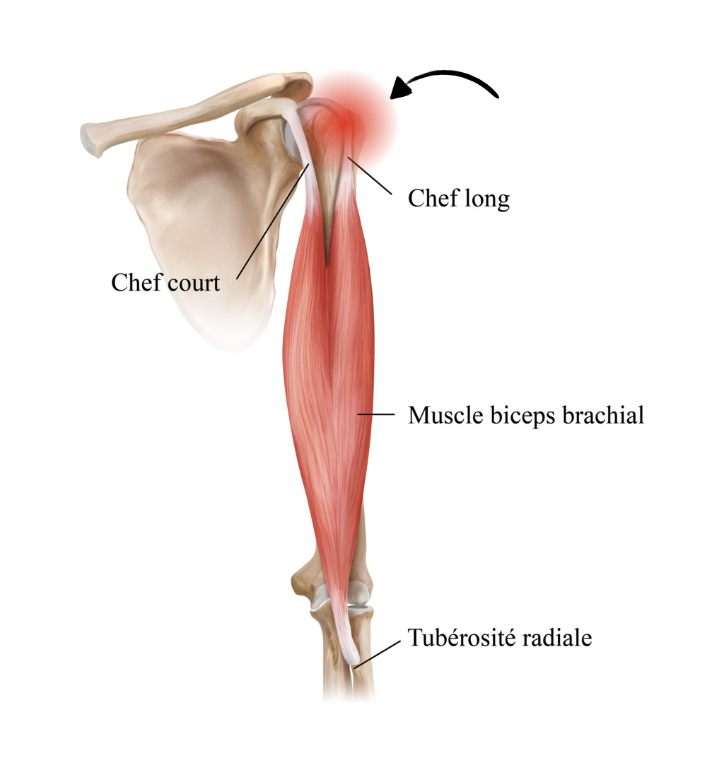 TENDINOPATHIE DU BICEPS BRACHIAL™ Le guide complet pour tout savoir sur les 2 tendinopathies du