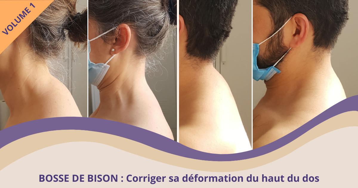 Hypercyphose Et Bosse De Bison Corriger Sa Deformation Du Haut Du Dos Volume 1 2