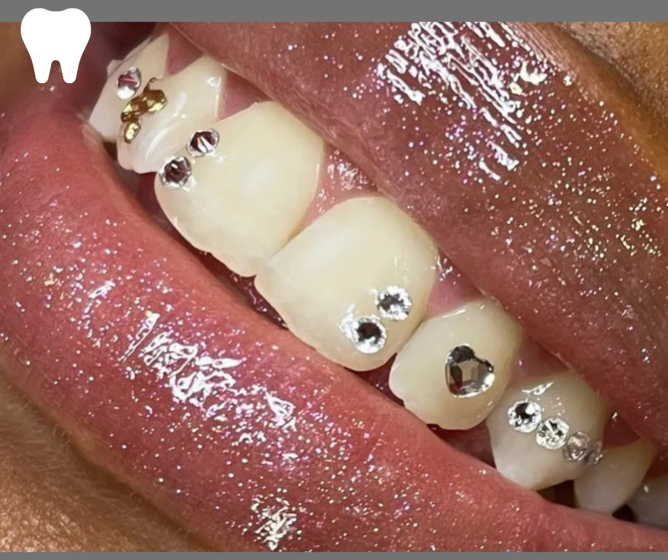 Teeth Whitening + Tooth Gem 💎 - Belle Beauty Academy