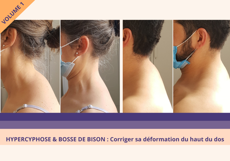 Hypercyphose Et Bosse De Bison Corriger Sa Deformation Du Haut Du Dos Volume 1 2