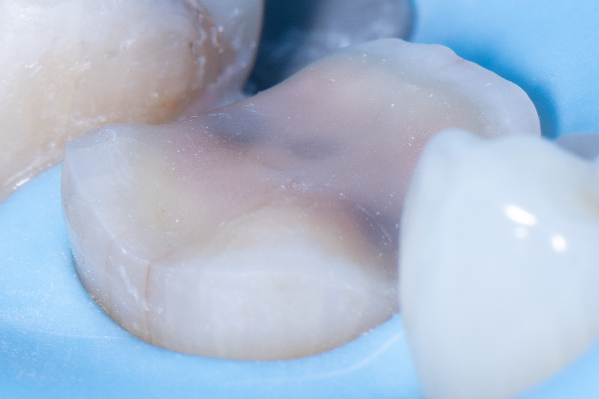 Overlay & Onlay Design