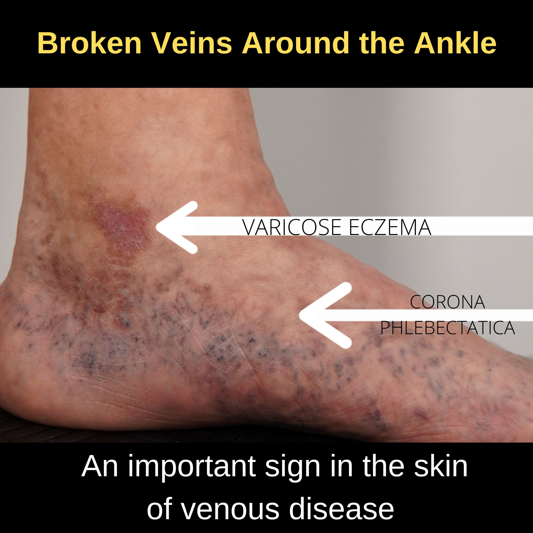 Microsclerotherapy Treatment for Leg Spider Veins